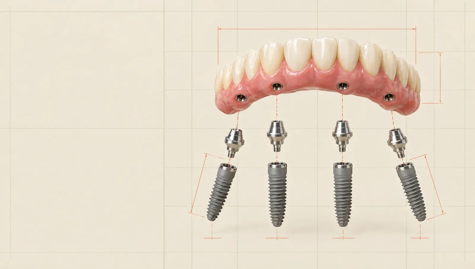 Exploded illustration of a fixed upper full-arch bridge above four titanium implants with multi-unit abutments, the back two tilted