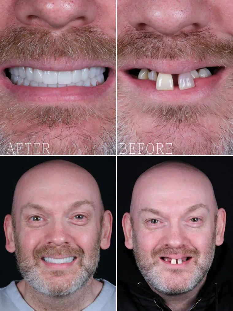 Precious Dental patient, implants and zirconia, after (left) and before (right), as published on dentprecious.com