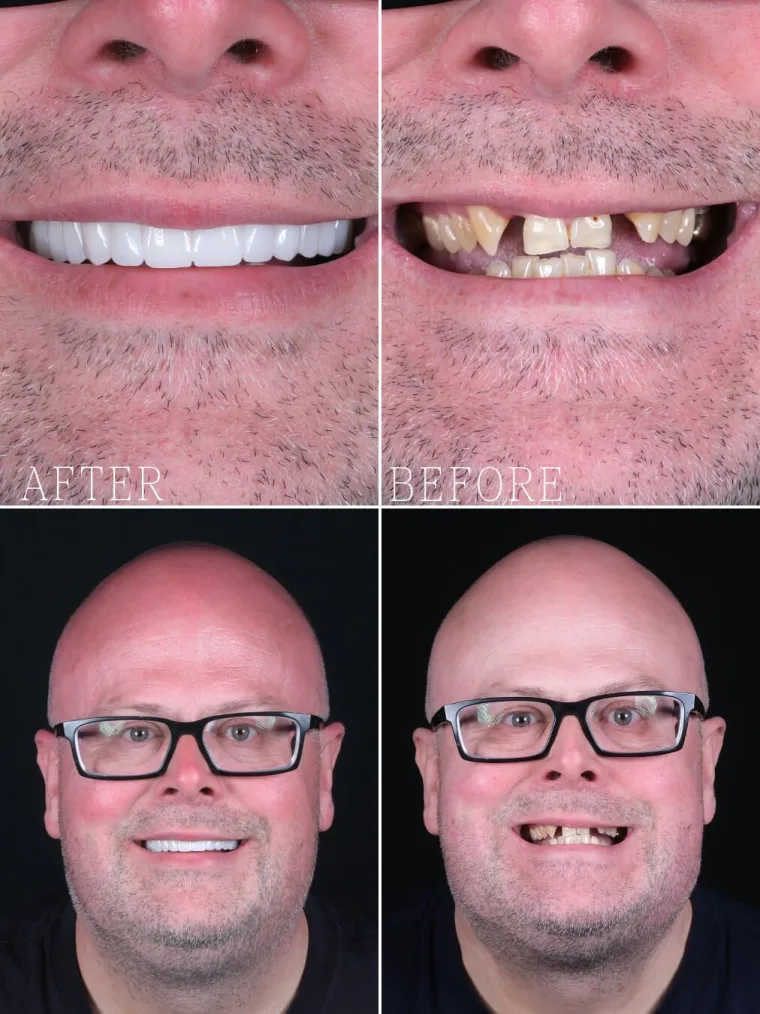 Precious Dental patient, full-mouth restoration, after (left) and before (right), as published on dentprecious.com