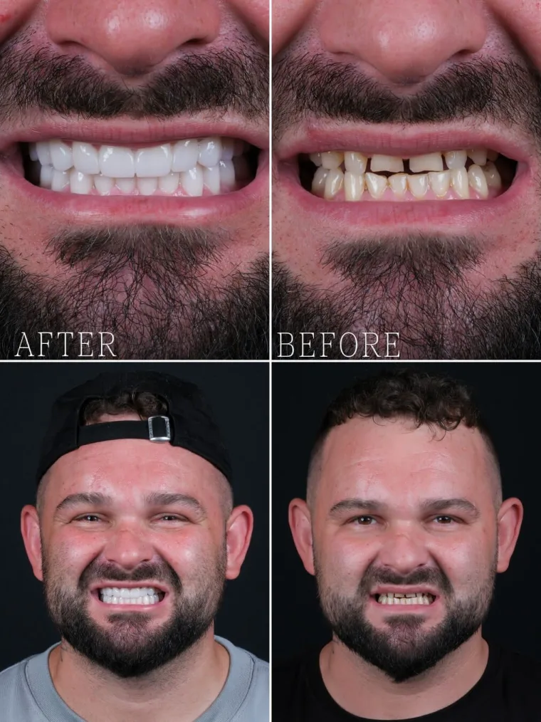 Precious Dental patient, all-on-6, after (left) and before (right), as published on dentprecious.com
